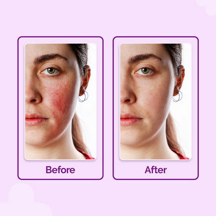 The Derma Co Hypochlorous Anti-Acne Hydrating Spray