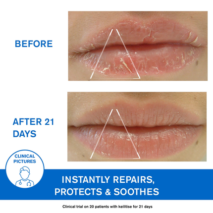 Uriage Bariederm-Cica Protecting Lip Balm For Dry,Cracked & Chapped Lips With Squalane & PHytosterol